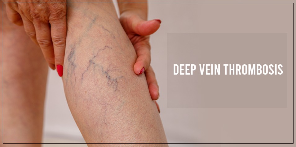 Clinical condition of deep vein thrombosis. A) A poor blood flow